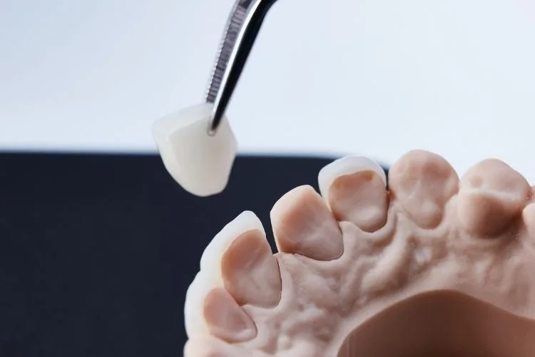 Dental veneers